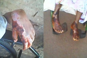  queimaduras de 3º grau nos pés e nas mãos