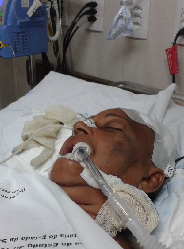 Maria Fortunata Rodrigues Pereira Martins, de 57 anos, entubada no HGP