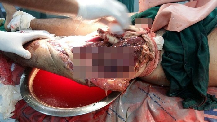 Imagem chocante da perna de Francisco da Silva que está sendo mostrada para que o leitor tenha ideia da gravidade dos fatos. Braço ficou em estado ainda pior.