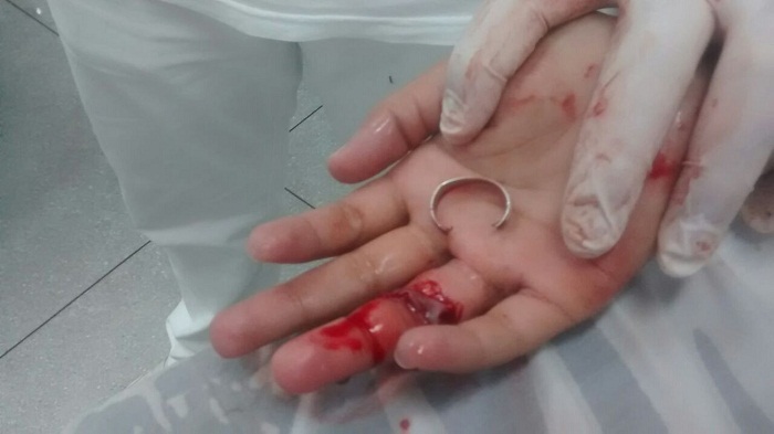 Jovem sofreu corte profundo no dedo após aliança prender em varal